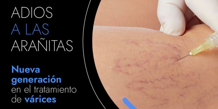 Varixio para Arañitas Telangiectasias
